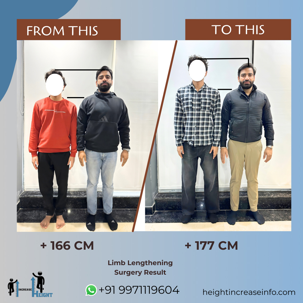 Limb Lengthening Result 1